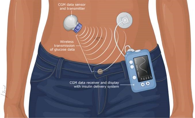 Graphic for use of personal insulin pumps.